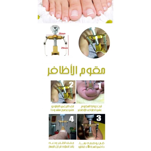 Ingrown Toenail Fixer Device: Pain Relief & Nail Correction - Image 3